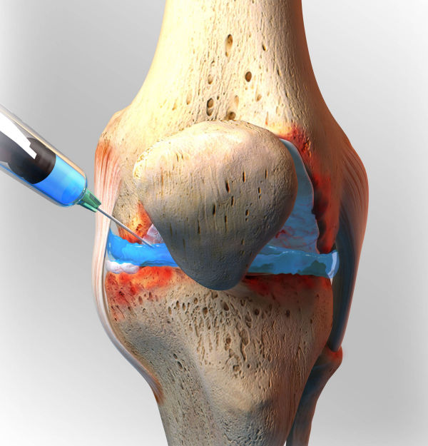 Εικόνα ένεσης PRP στην άρθρωση του γόνατου