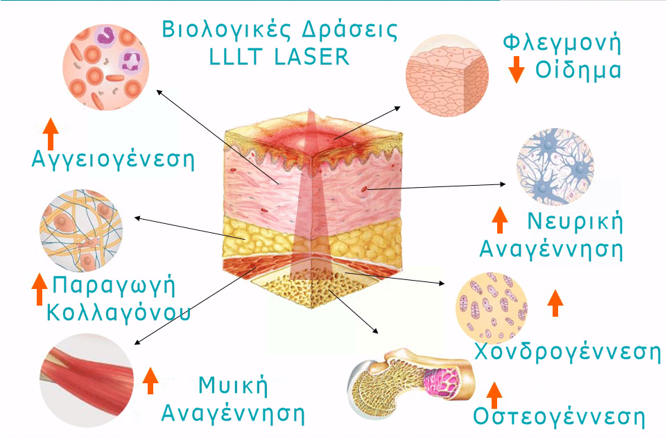 Βιολογικές δράσεις LASER στην θεραπεία της δισκοκήλης